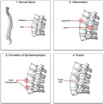 Ankylosing process