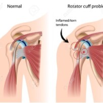 Shoulder-Impingement