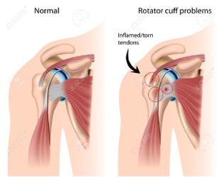 shoulder impingement diagnosis