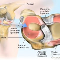 Meniscus injury of the knee 2 - bucket handle tear