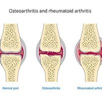 512px-Osteoarthritis_and_rheumatoid_arthritis_-_Normal_joint_Osteoarthr_--_Smart-Servier