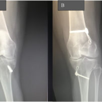 Long term effect of the Pilates method in a reconstructed knee with osteoarthritis