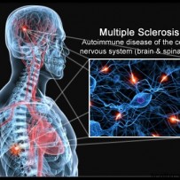 PILATES – Multiple Sclerosis MS_Image