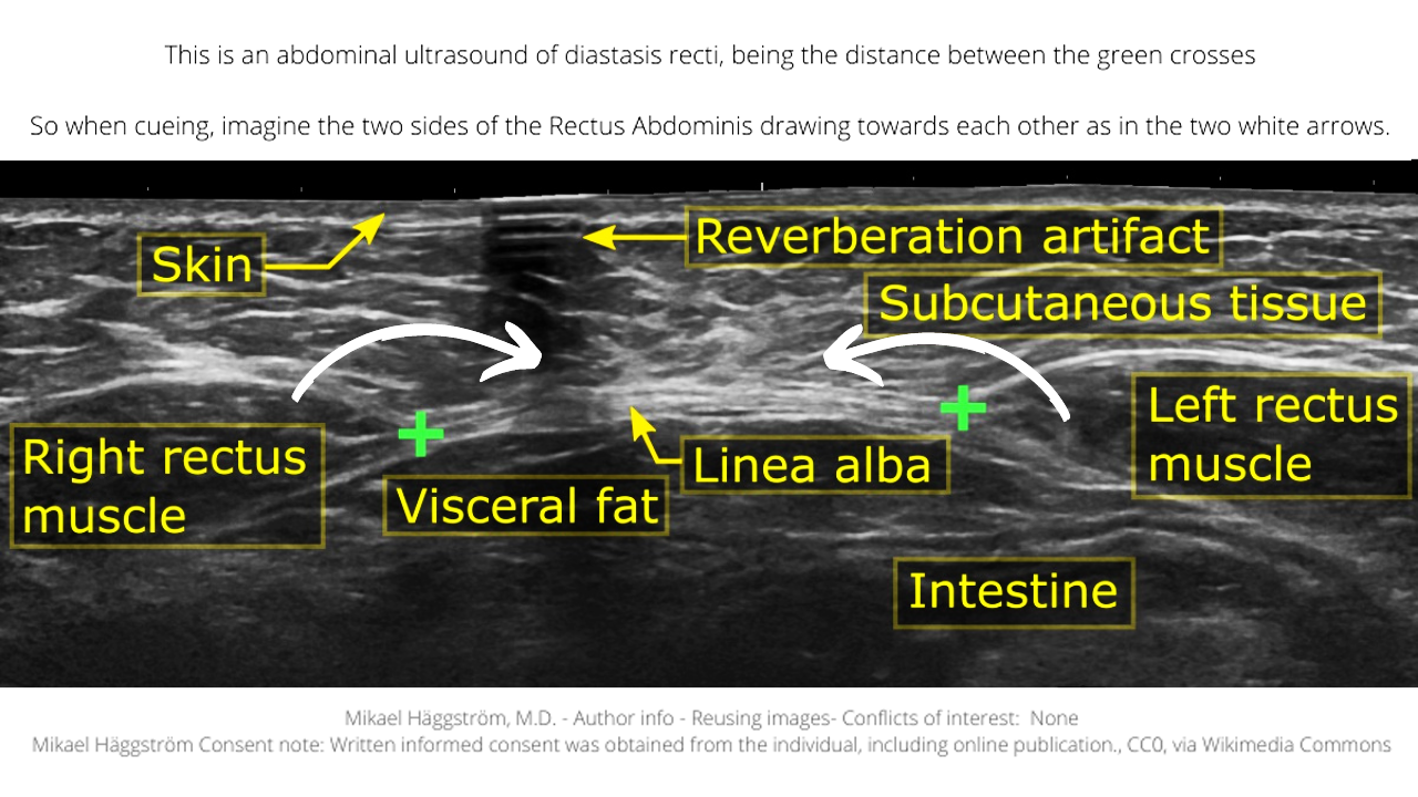 abdominal ultrasound of diastasis recti