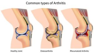 Arthritic joints
