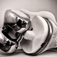Article: How to help my client who is having or had a total knee replacement knee replacement