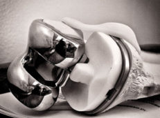 knee replacement