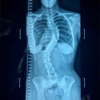 scoliosis spine image